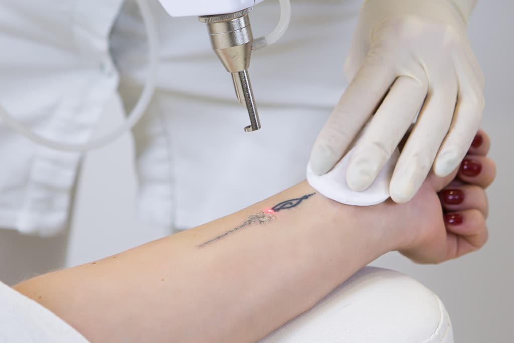 How Many Sessions Does It Take To Remove a Tattoo – Laser device treating black ink tattoo on wrist during removal session, showing ink breakdown in progress.